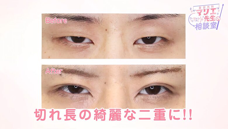二重埋没法の術前術後を比較した目元のアップ写真