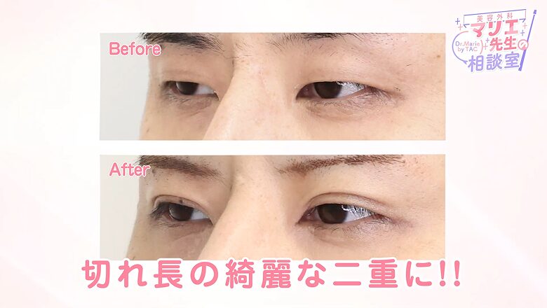 斜めから見た二重埋没法の術前術後比較写真