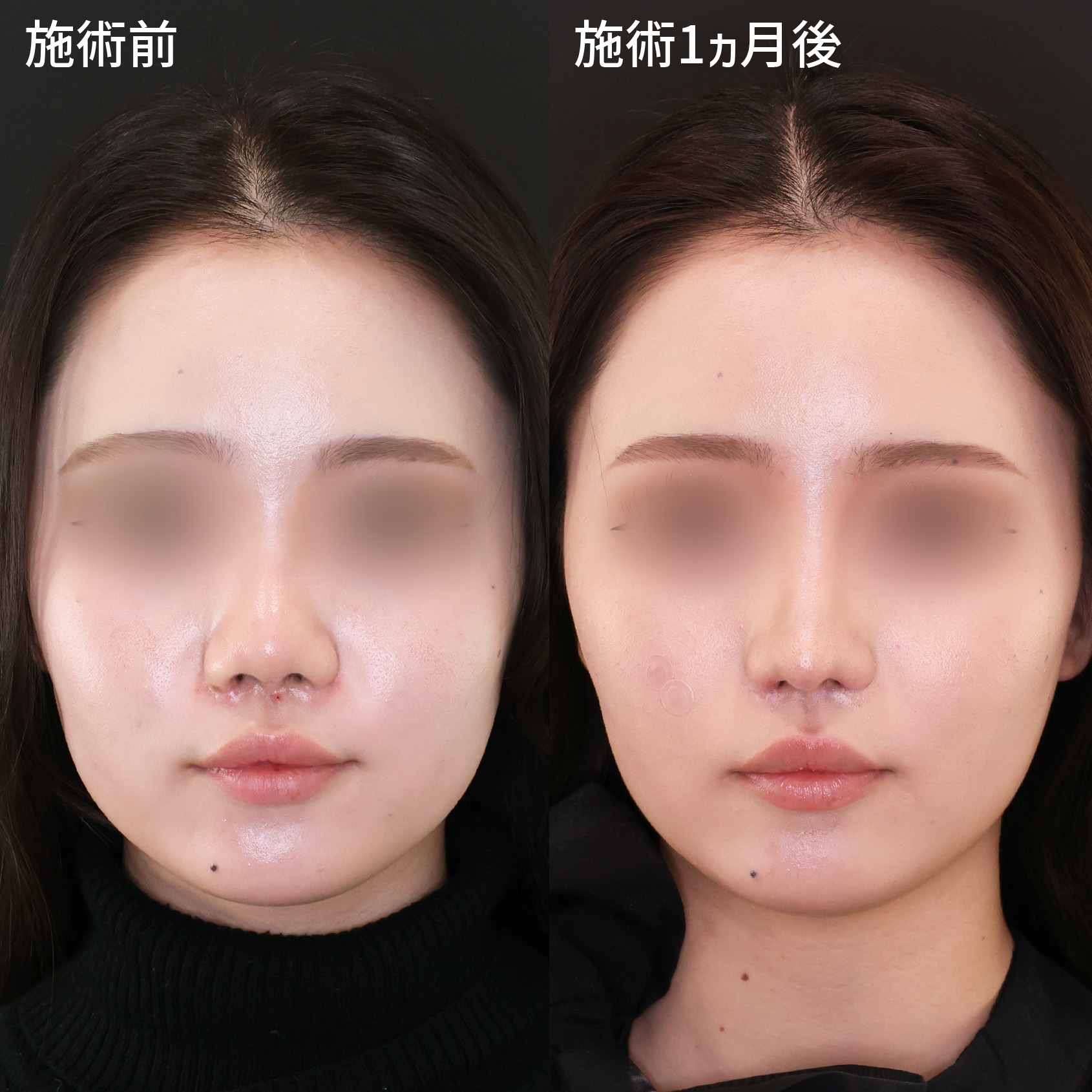 鼻中隔延長術/鼻尖形成・鼻尖縮小/鼻翼挙上術の症例写真 施術前後