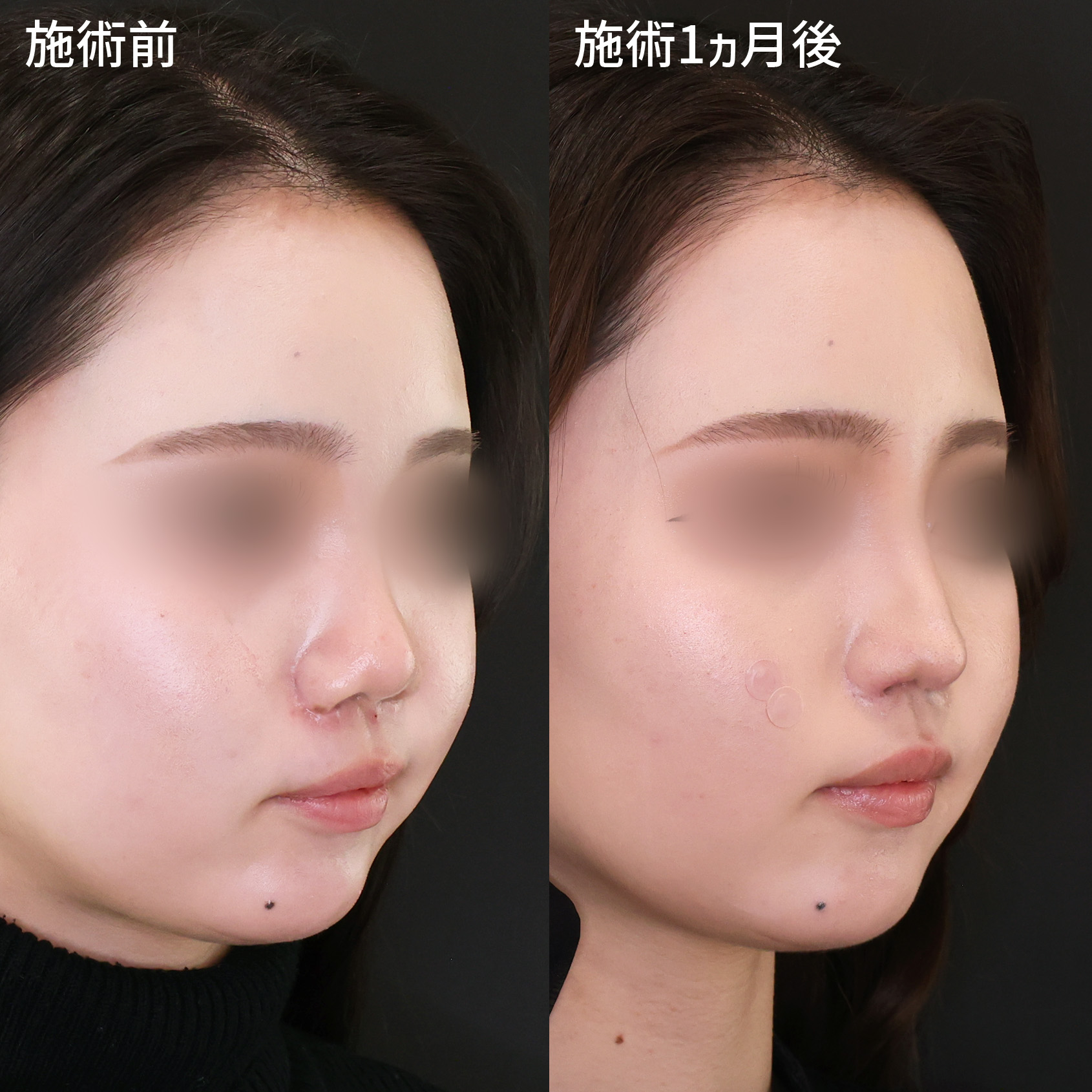 鼻中隔延長術/鼻尖形成・鼻尖縮小/鼻翼挙上術の症例写真 施術前後