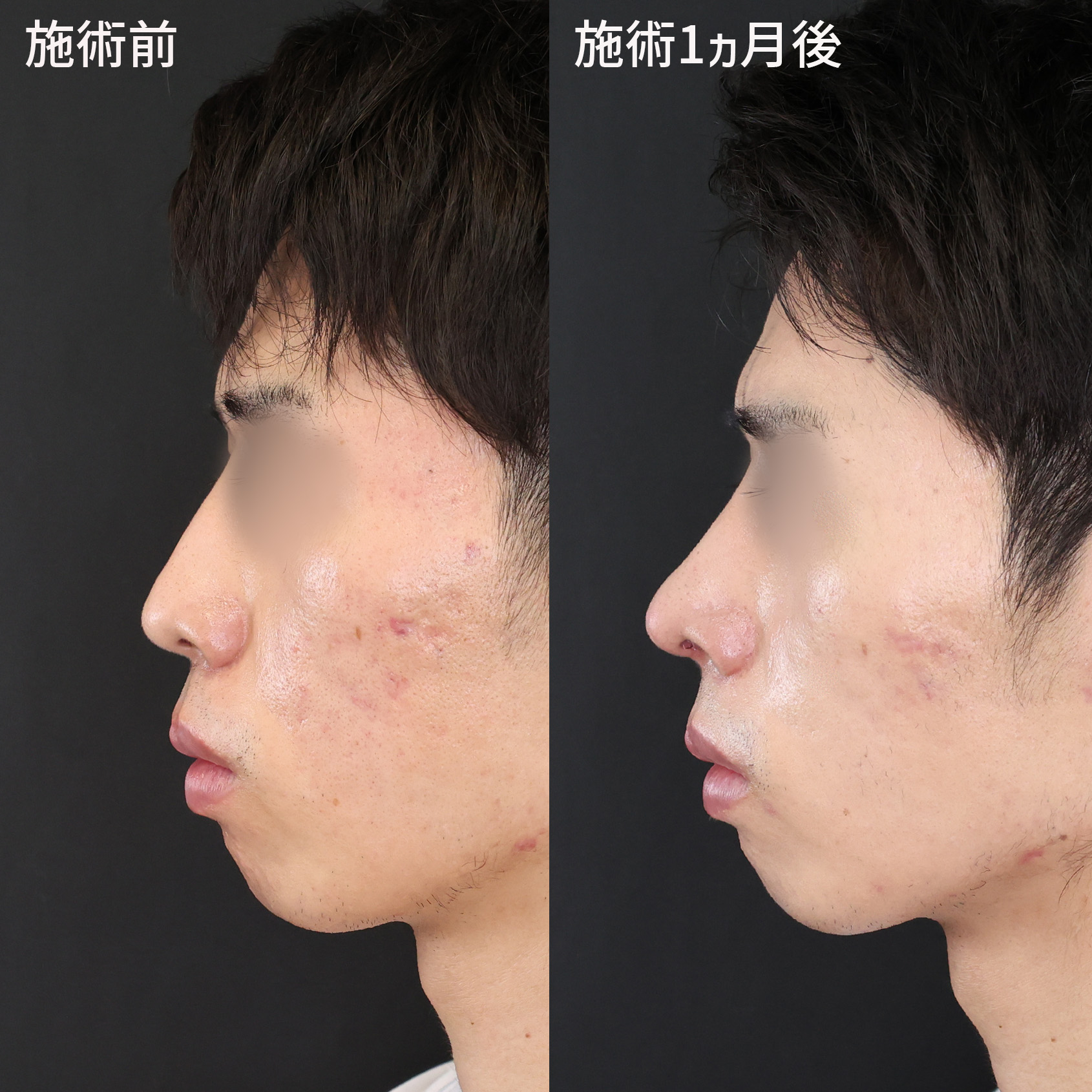 高いデザイン力と技術力で洗練された印象の鼻先へ！！【TAクリニックの鼻整形】