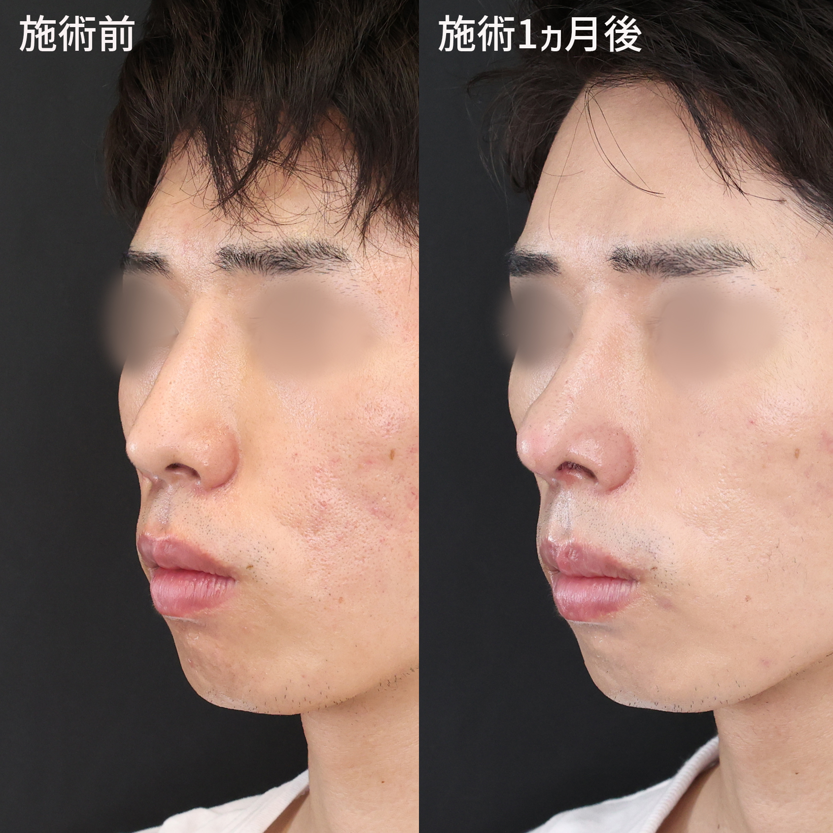 鼻中隔延長術/鼻先軟骨移植/隆鼻術（プロテーゼ・自家組織）の症例写真 施術前後 