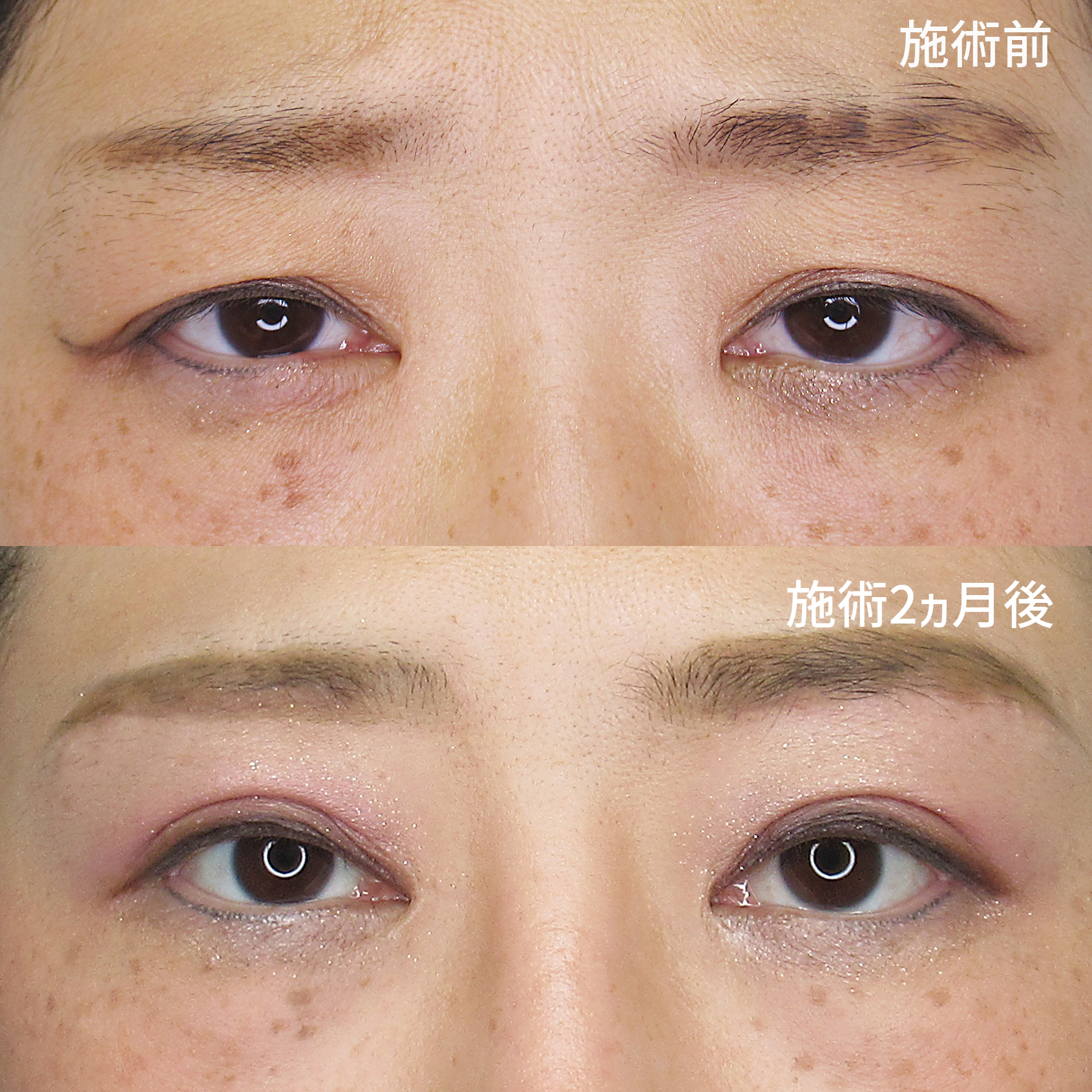 重たかったまぶたを眉毛下切開でスッキリ見せる