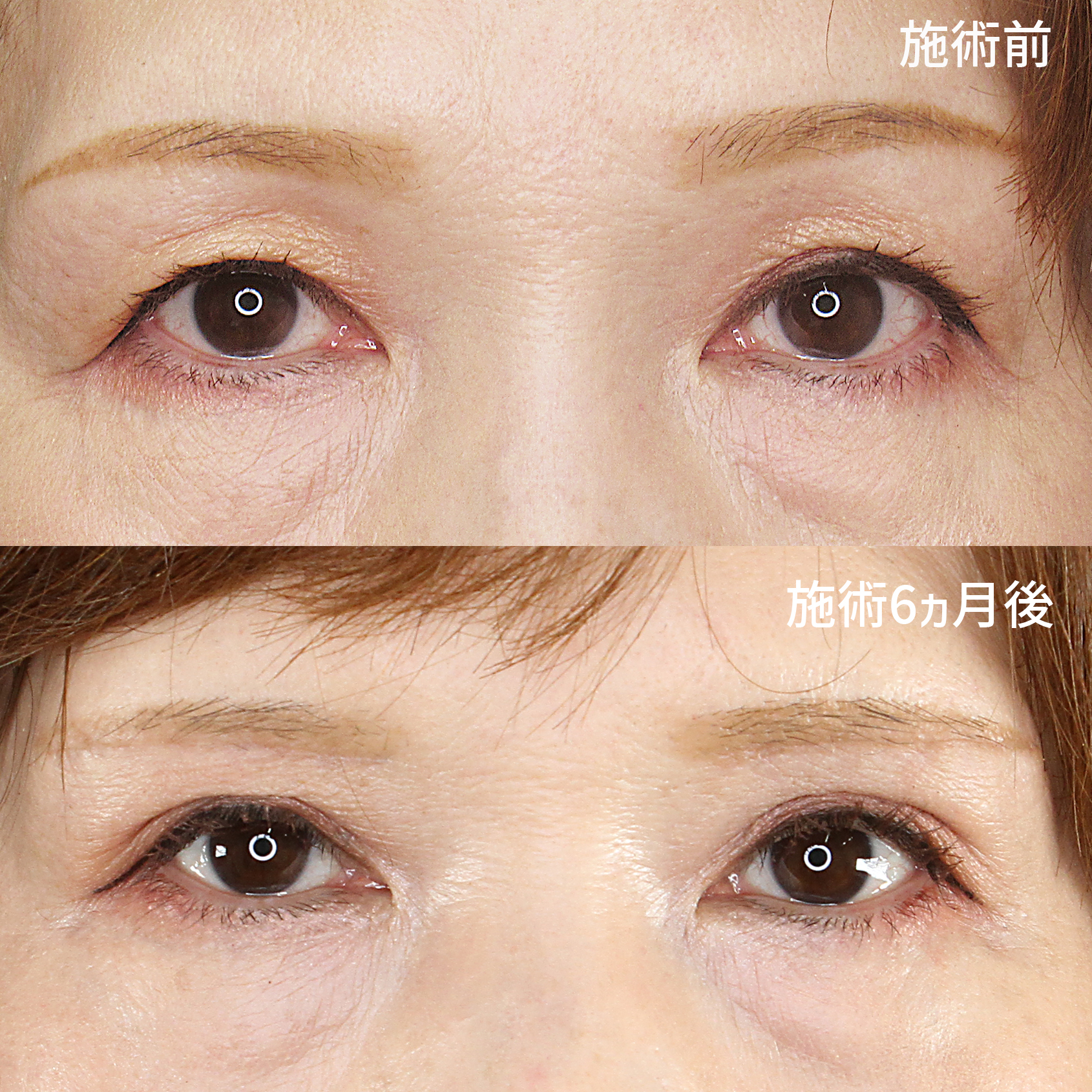 加齢による目の上のたるみを改善し、若々しい印象の目元に。