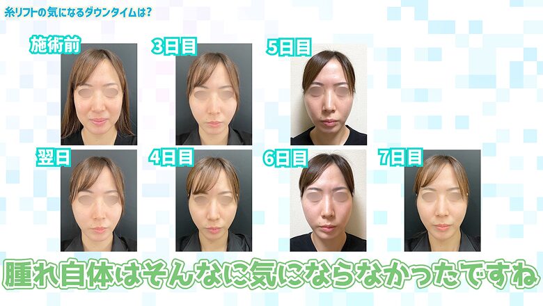 糸リフト術後の腫れはあまり気にならなかったと振り返る経過写真
