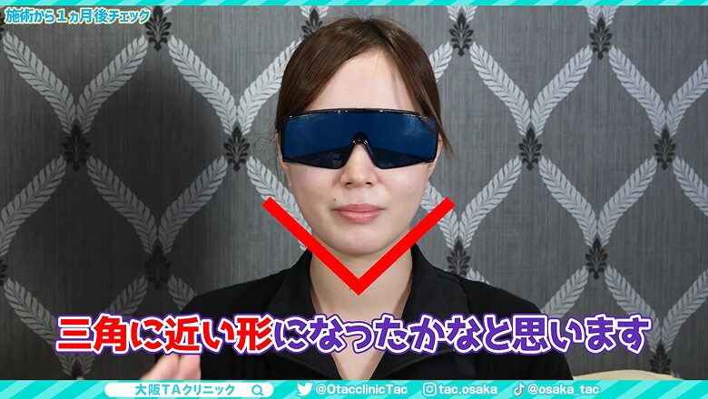 糸リフト後にフェイスラインが三角に近い形になった女性の顔