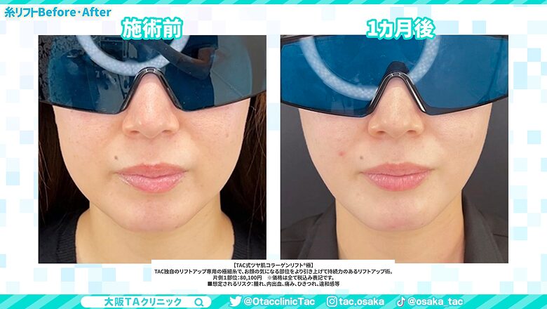 糸リフト施術前と1ヵ月後のフェイスラインを比較したビフォーアフター