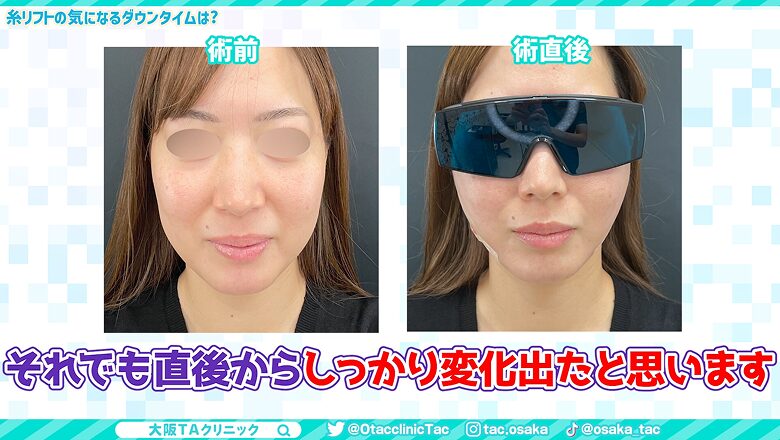 糸リフト術後3日目で頬がしっかり上がっている女性の顔写真