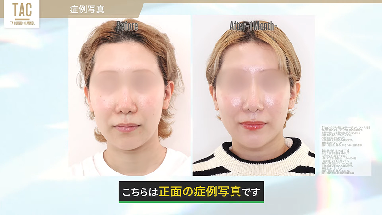 顎下の脂肪吸引と糸リフトの術前と術後1カ月の正面写真