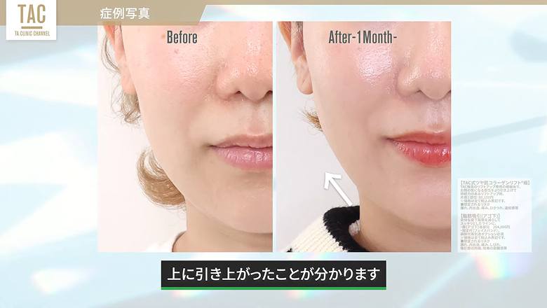 術前と術後1カ月の口元からフェイスラインの拡大比較
