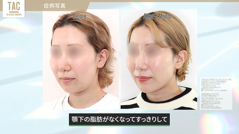 顎下の脂肪吸引と糸リフトの術前と術後1カ月の斜め写真