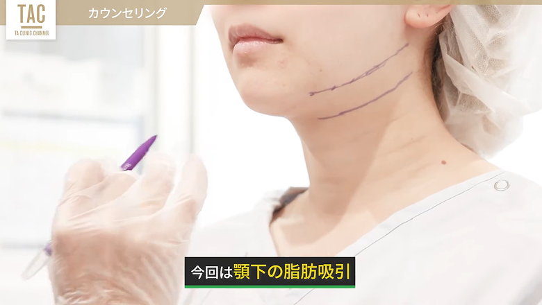 顎下の脂肪吸引に向けてフェイスラインにマーキングする様子
