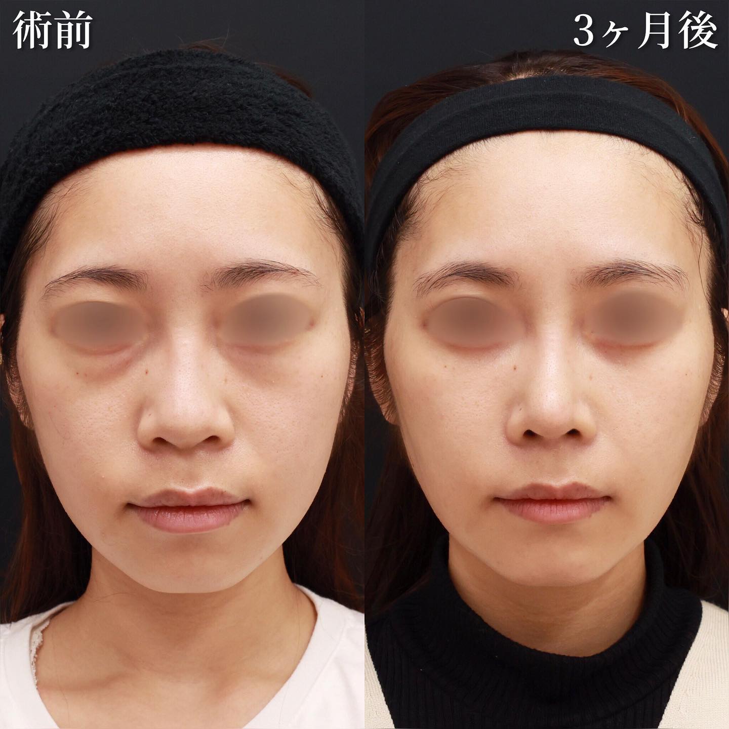 鼻中隔延長術/鼻先軟骨移植/鼻尖形成・鼻尖縮小の症例写真 施術前後 ３ヵ月