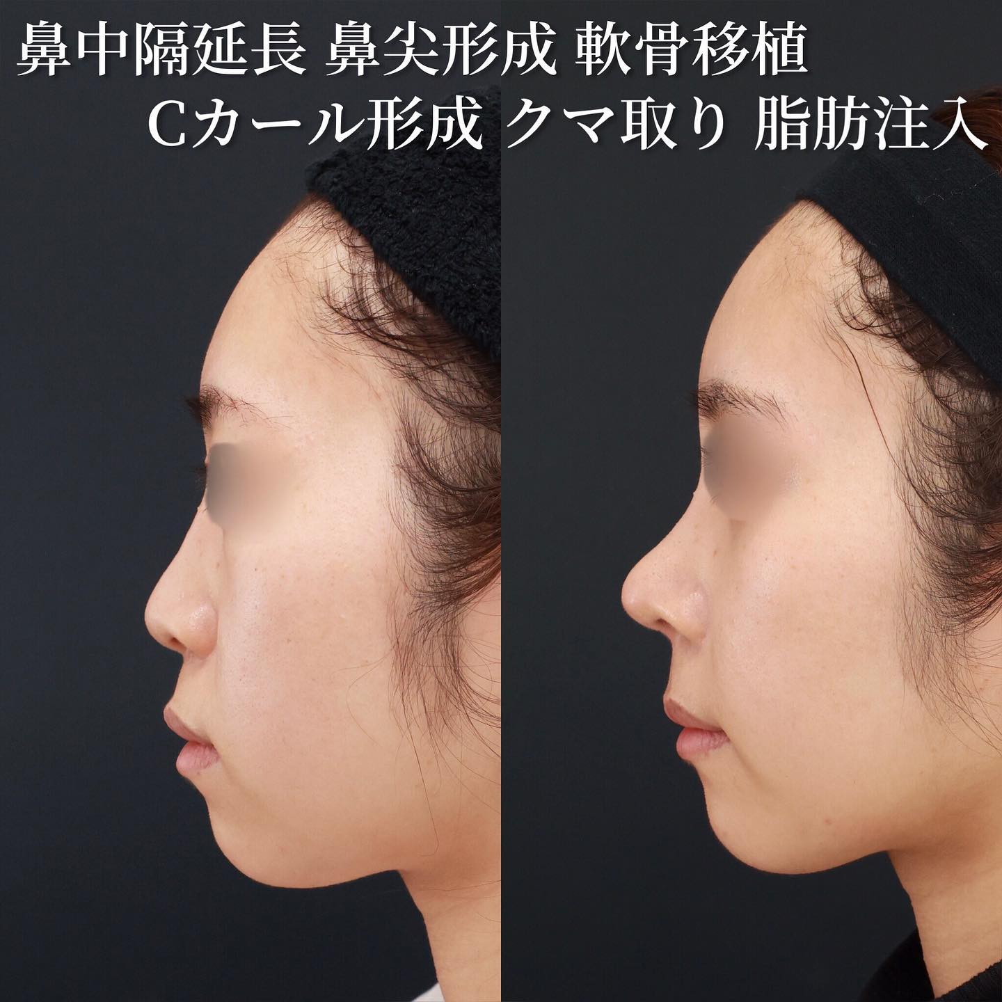 鼻中隔延長術/鼻先軟骨移植/鼻尖形成・鼻尖縮小の症例写真 施術前後 ３ヵ月