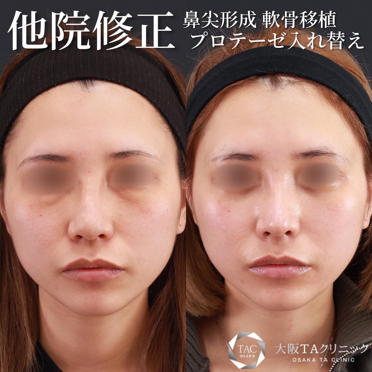 鼻先軟骨移植/鼻尖形成・鼻尖縮小/隆鼻術（プロテーゼ・自家組織）の症例写真 施術前後 