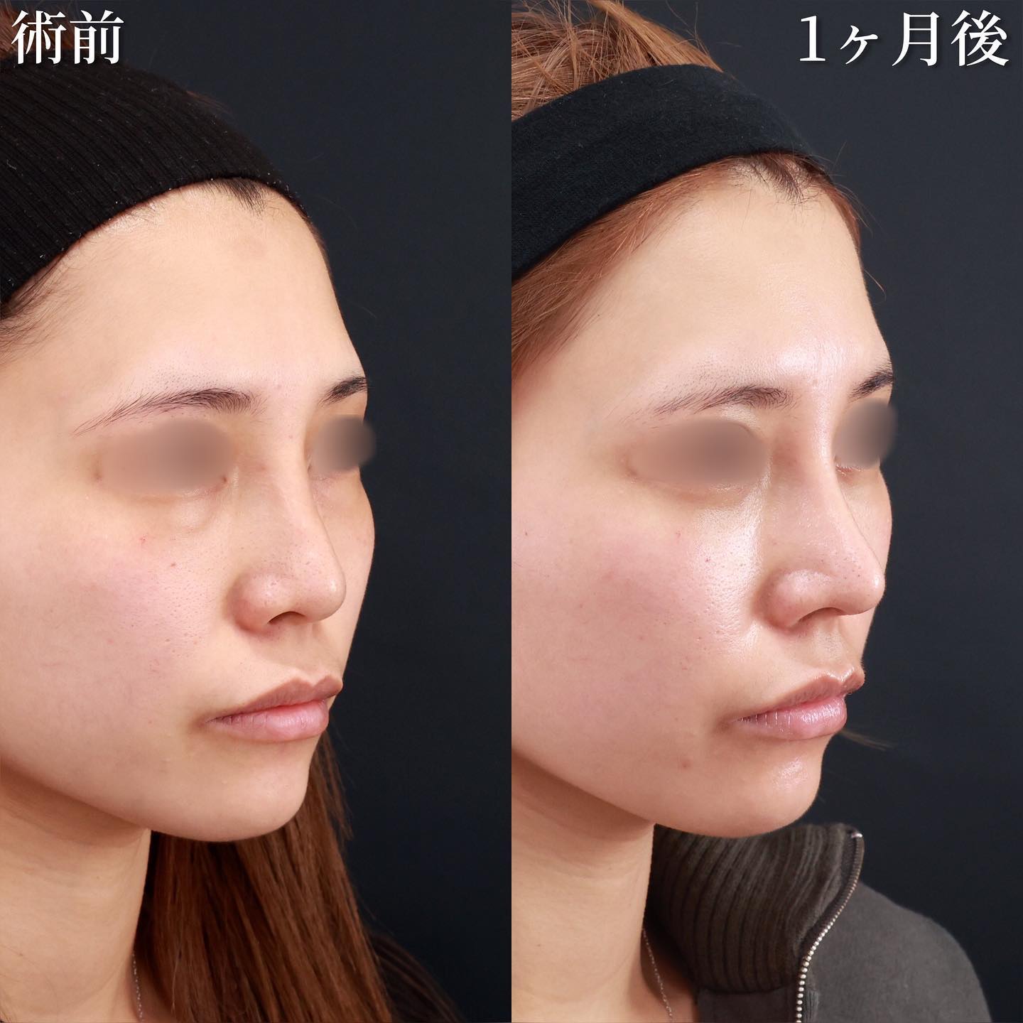 鼻先軟骨移植/鼻尖形成・鼻尖縮小/隆鼻術（プロテーゼ・自家組織）の症例写真 施術前後 １ヵ月