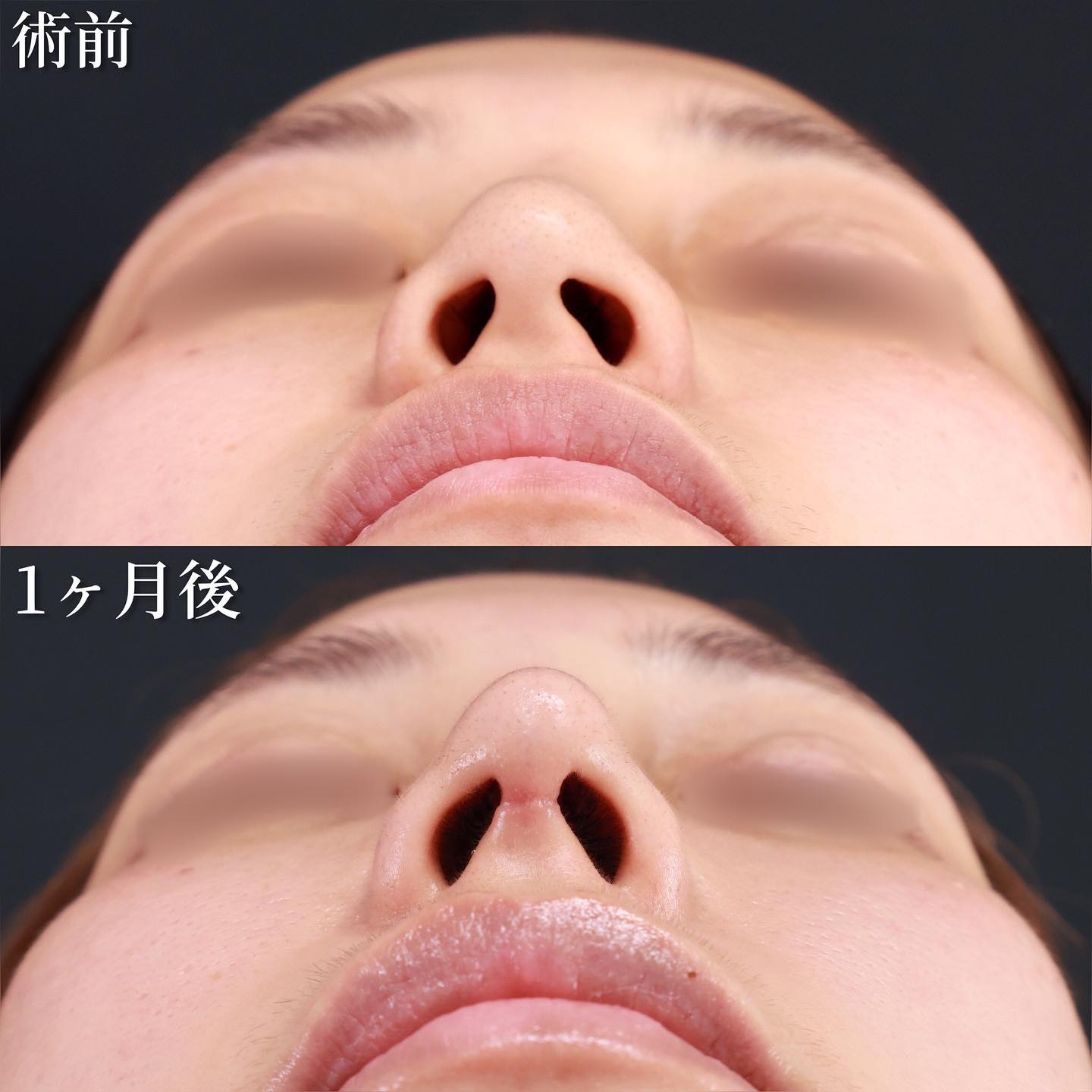 鼻先軟骨移植/鼻尖形成・鼻尖縮小/隆鼻術（プロテーゼ・自家組織）の症例写真 施術前後 