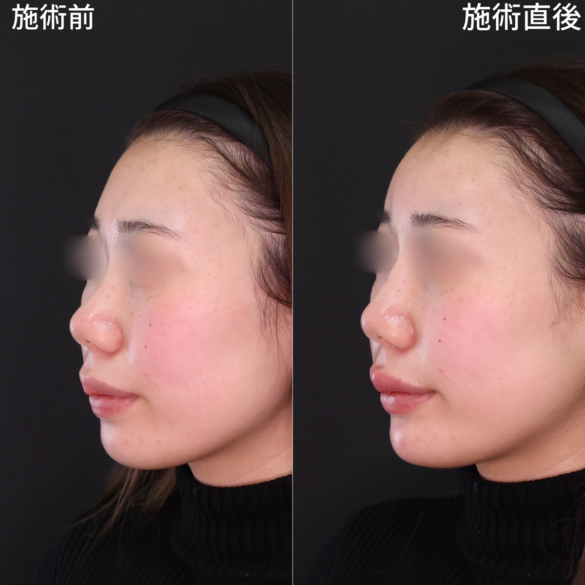 ヒアルロン酸だけでしっかり変化！立体的フェイスへ