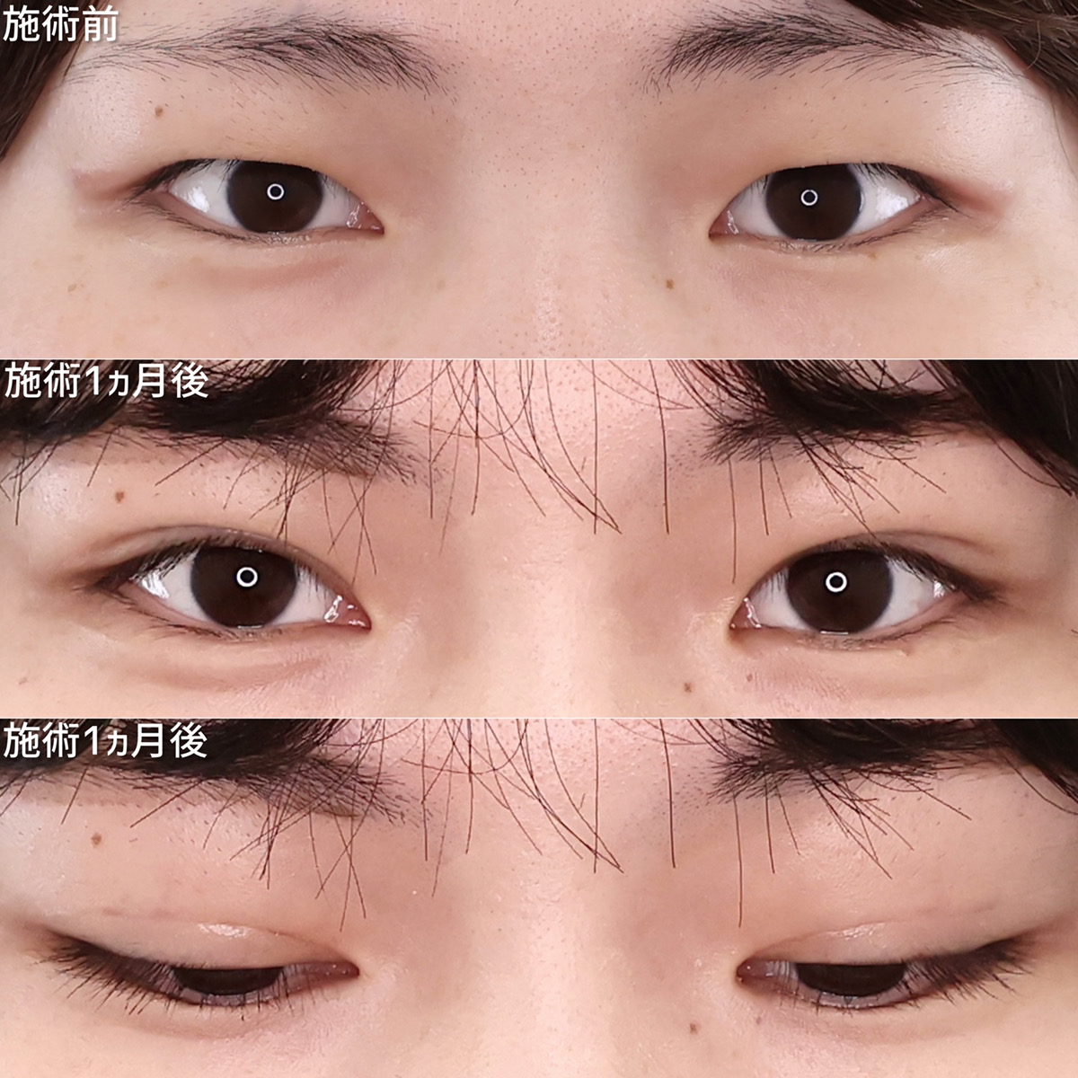 二重埋没法の症例写真 施術前後 