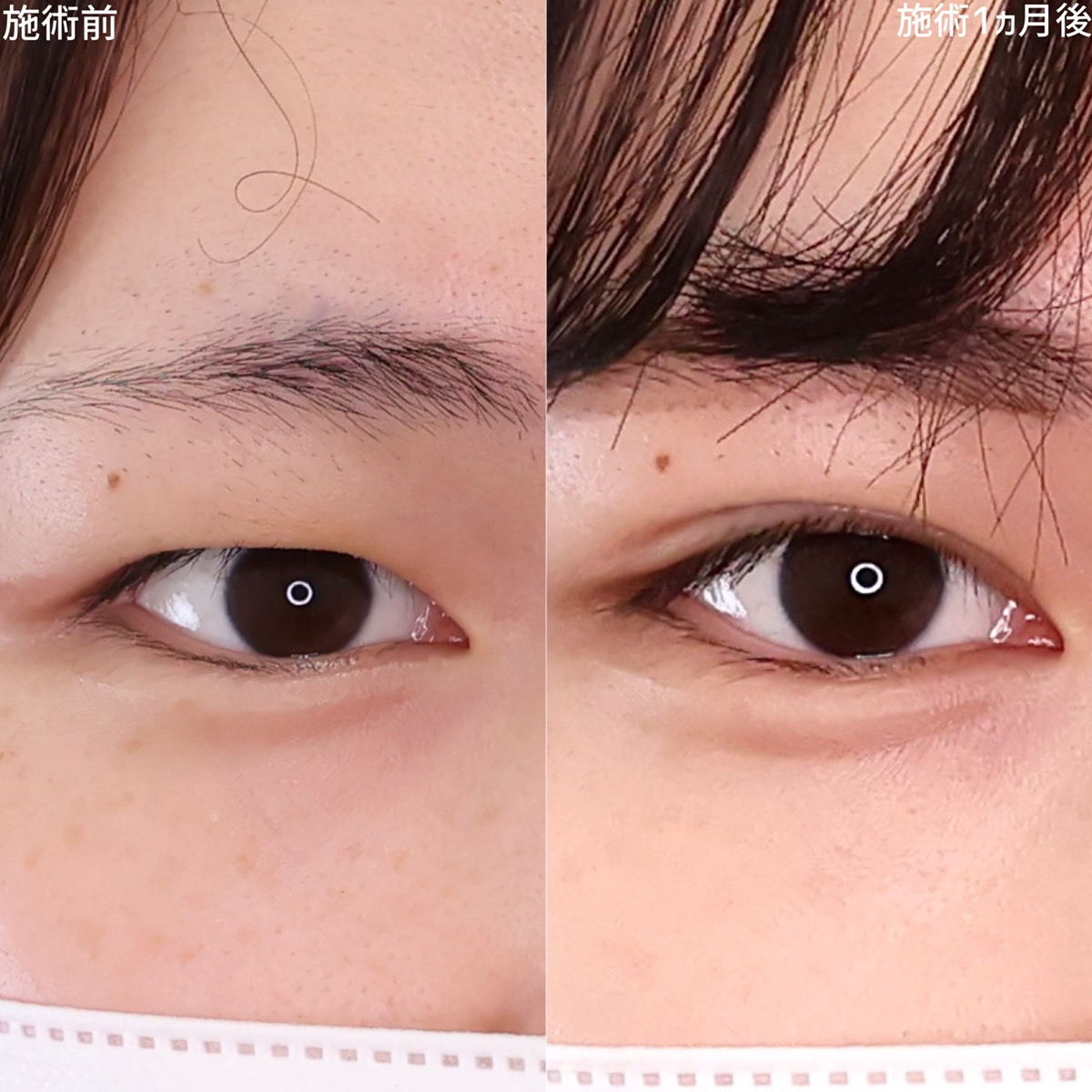 二重埋没法の症例写真 施術前後 