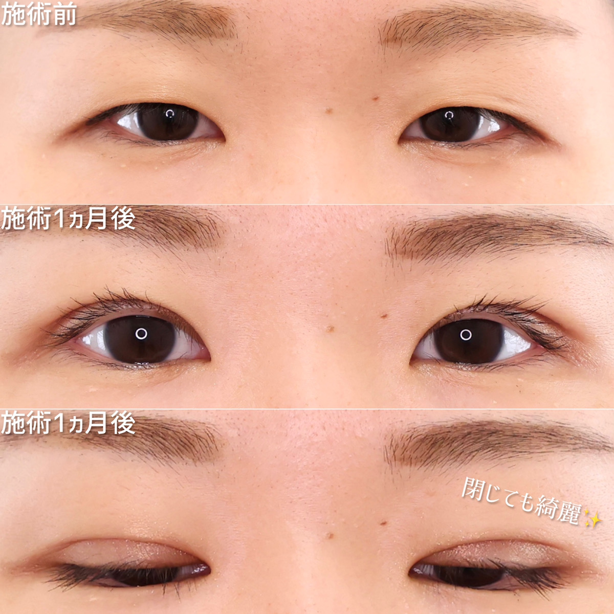 二重埋没法の症例写真 施術前後 