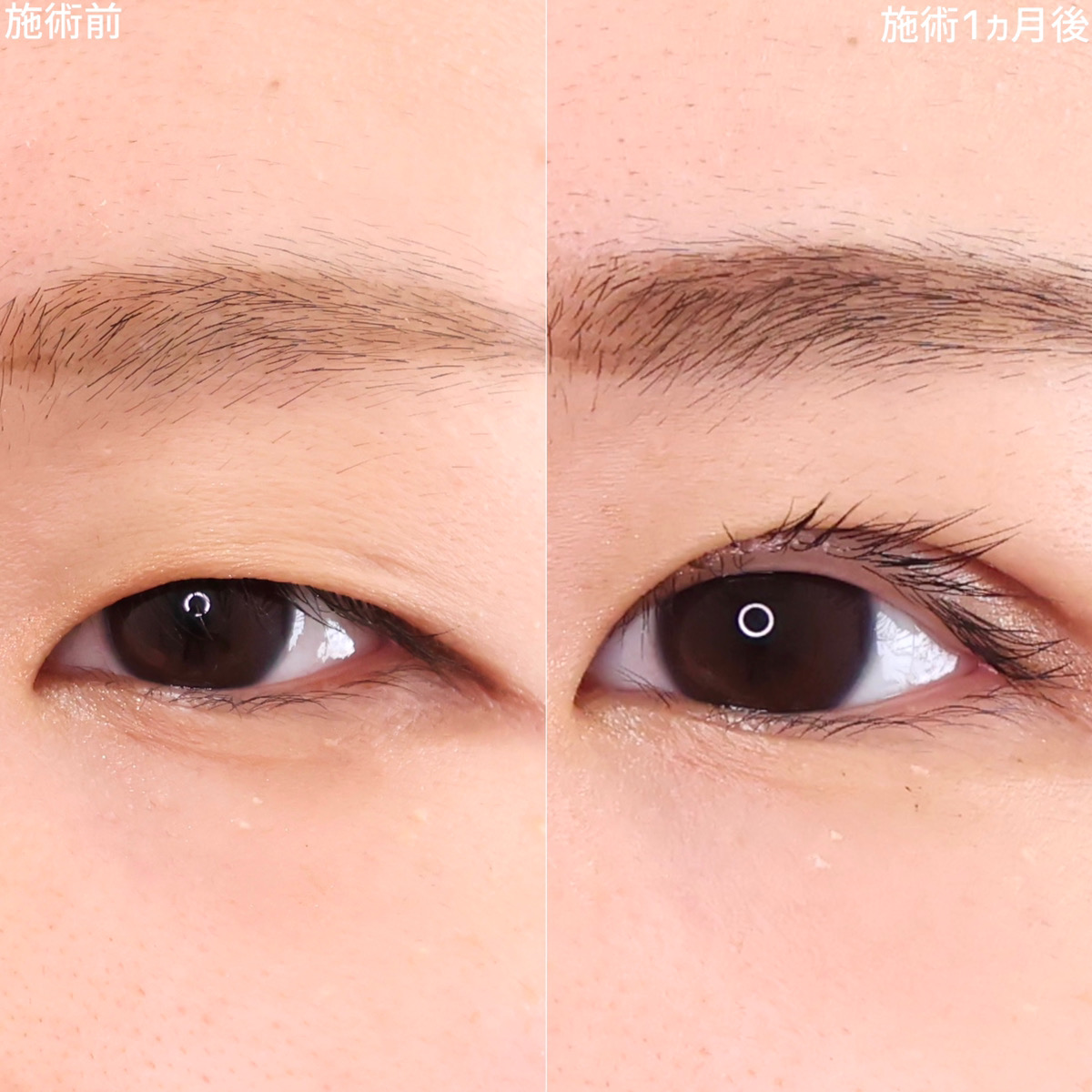 二重埋没法の症例写真 施術前後 