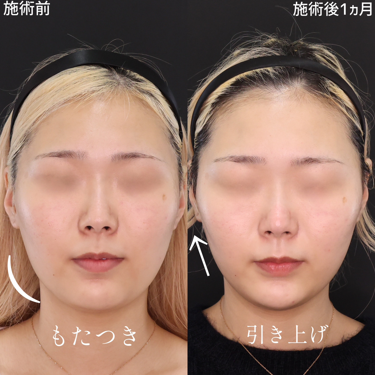 TAC式 ツヤ肌コラーゲンリフト®/顔の脂肪吸引/顎のヒアルロン酸注射の症例写真 施術前後 