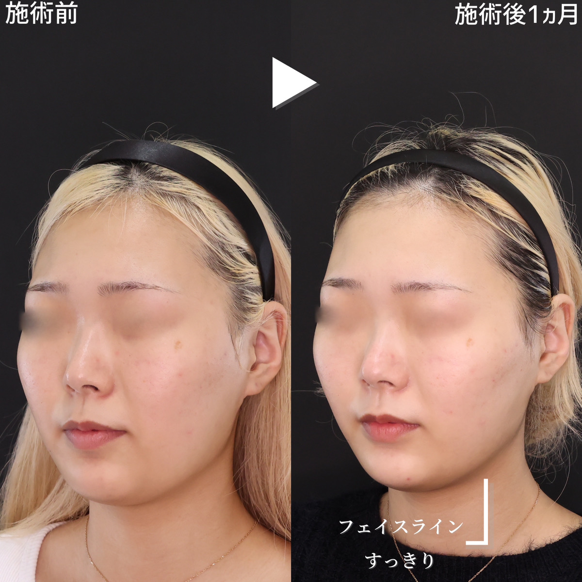 TAC式 ツヤ肌コラーゲンリフト®/顔の脂肪吸引/顎のヒアルロン酸注射の症例写真 施術前後 