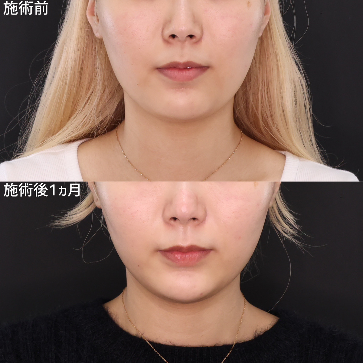 TAC式 ツヤ肌コラーゲンリフト®/顔の脂肪吸引/顎のヒアルロン酸注射の症例写真 施術前後 