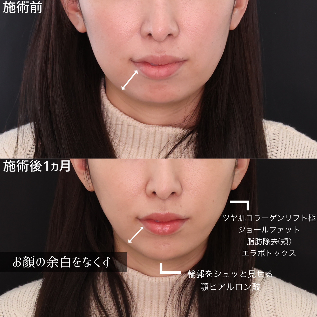 TAC式 ツヤ肌コラーゲンリフト®/ジョールファット除去/顔の脂肪吸引の症例写真 施術前後 