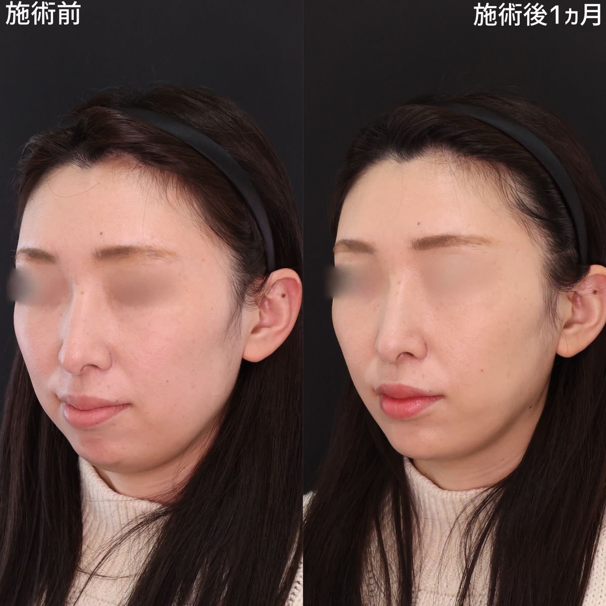 TAC式 ツヤ肌コラーゲンリフト®/ジョールファット除去/顔の脂肪吸引の症例写真 施術前後 