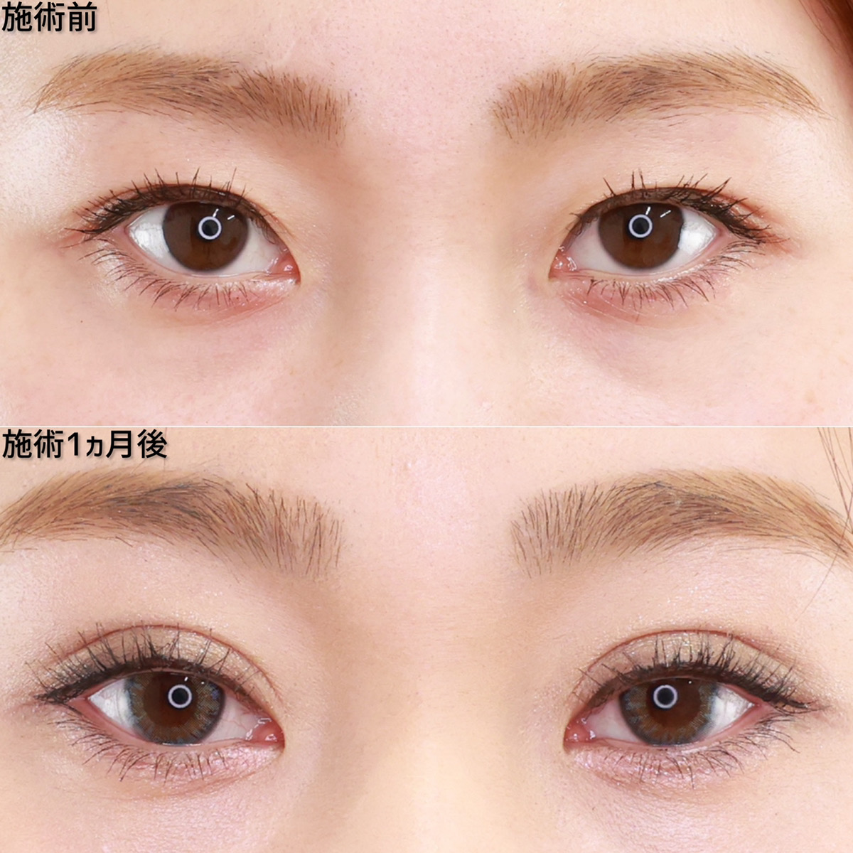 二重幅をぐっと広げ、華やか平行型二重