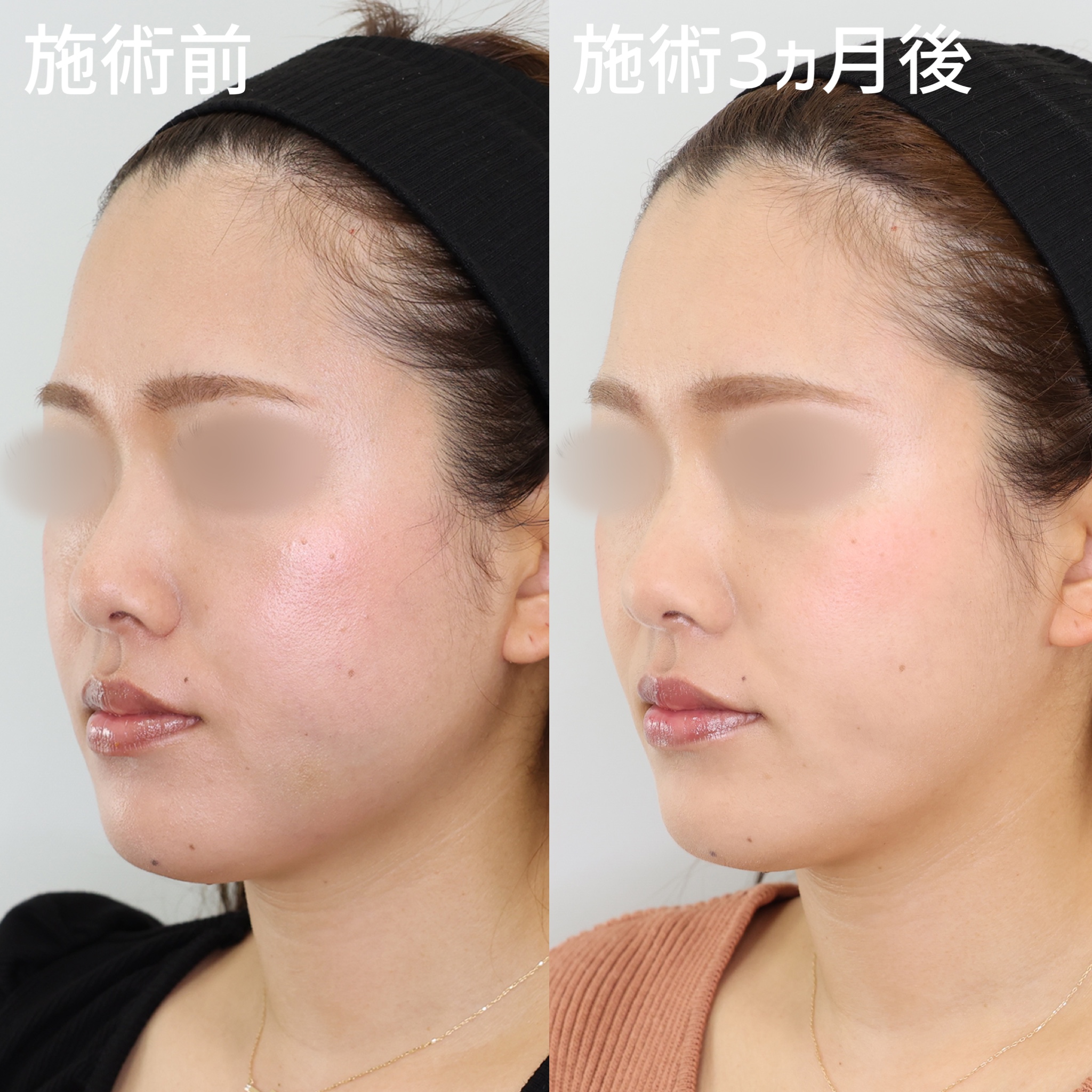 ジョールファット除去/TAC式 ツヤ肌コラーゲンリフト®の症例写真 施術前後