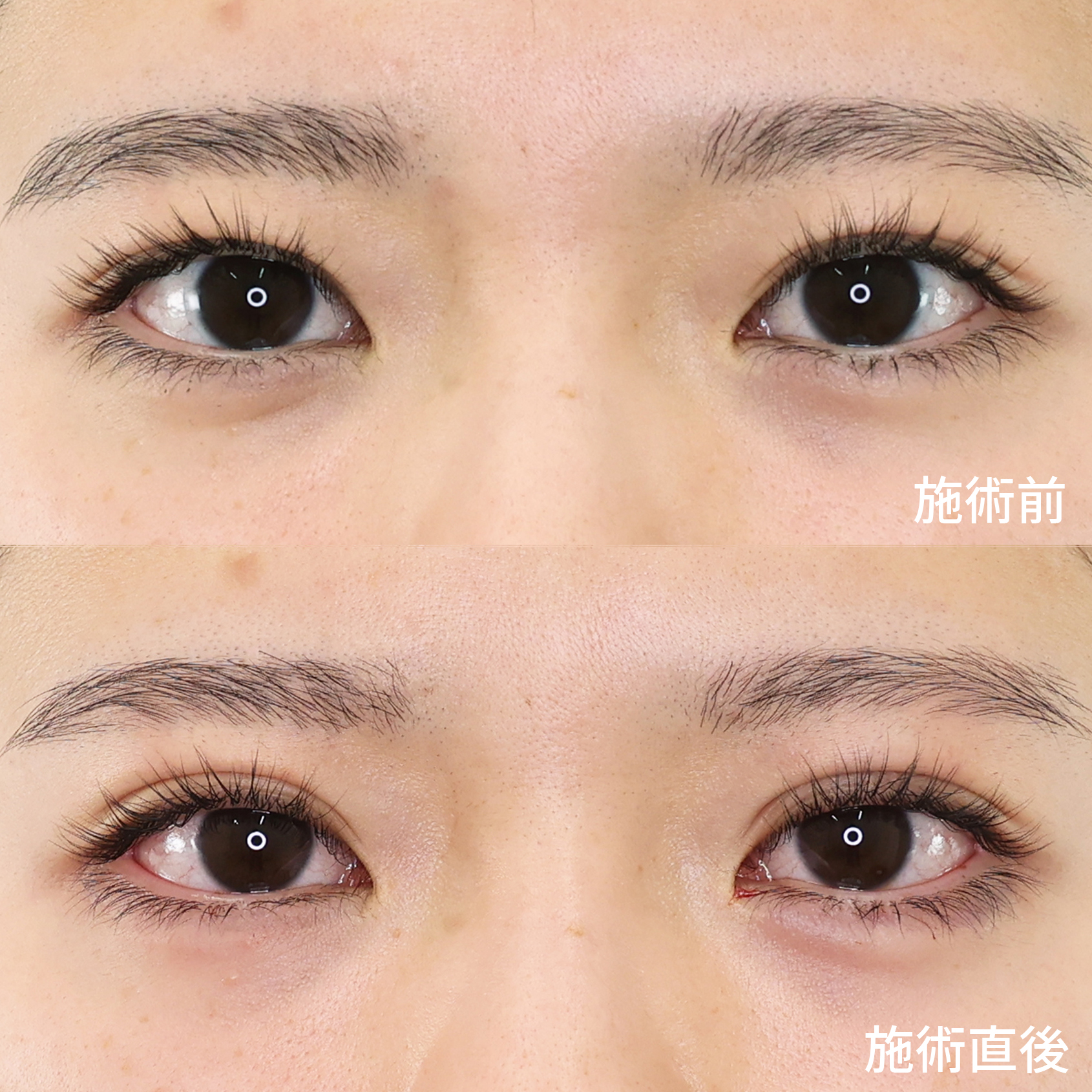 ダウンタイムが気になる方必見！【クイックコスメリングダブル】