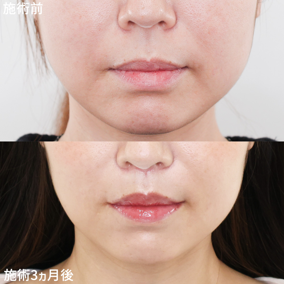 《人中短縮×口角挙上》優しく若々しい口元の印象に