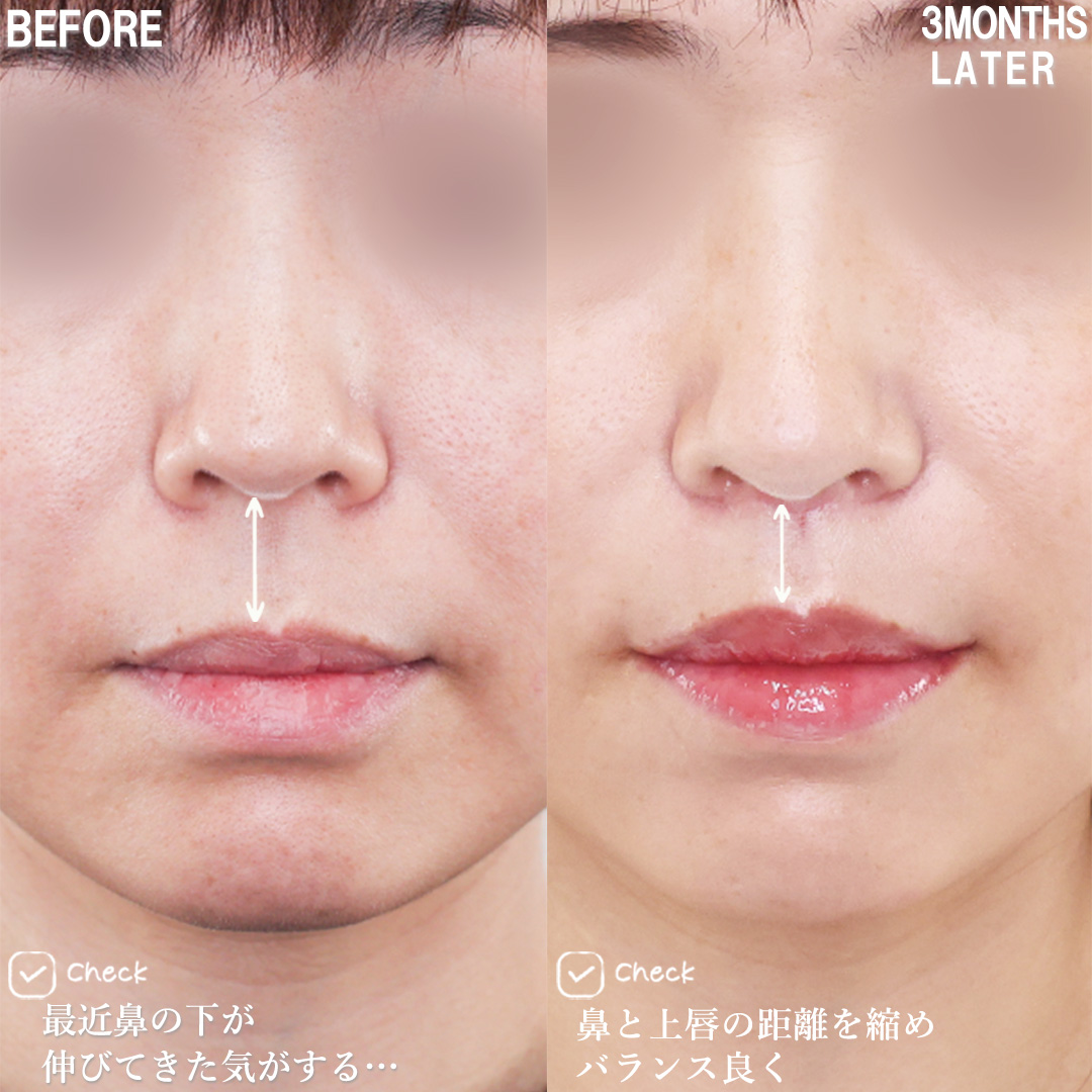 人中短縮術(リップリフト)・外側人中短縮術/口角挙上・リフト（マイクロ切開法・内側法/口内法）の症例写真 施術前後 
