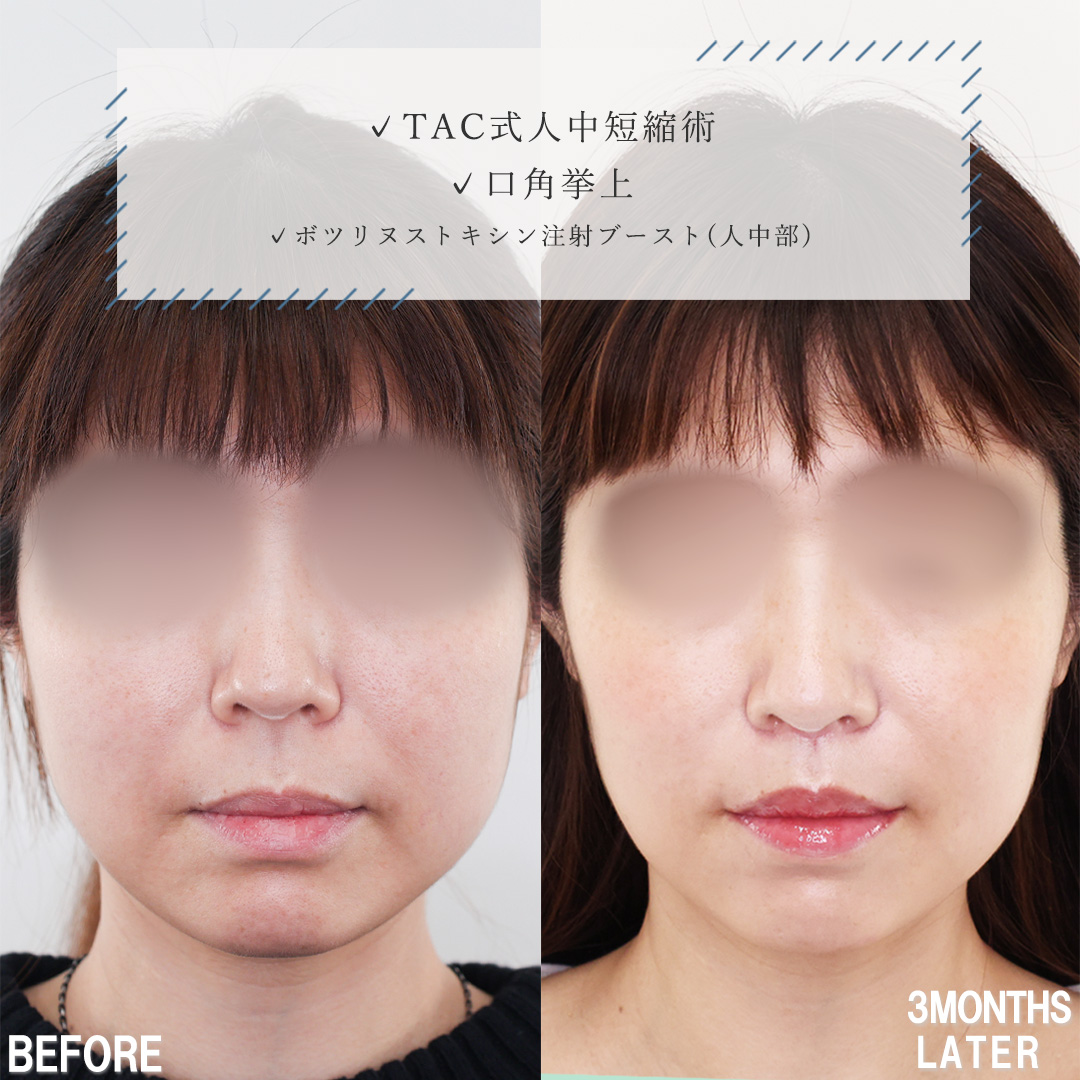 人中短縮術(リップリフト)・外側人中短縮術/口角挙上・リフト（マイクロ切開法・内側法/口内法）の症例写真 施術前後 