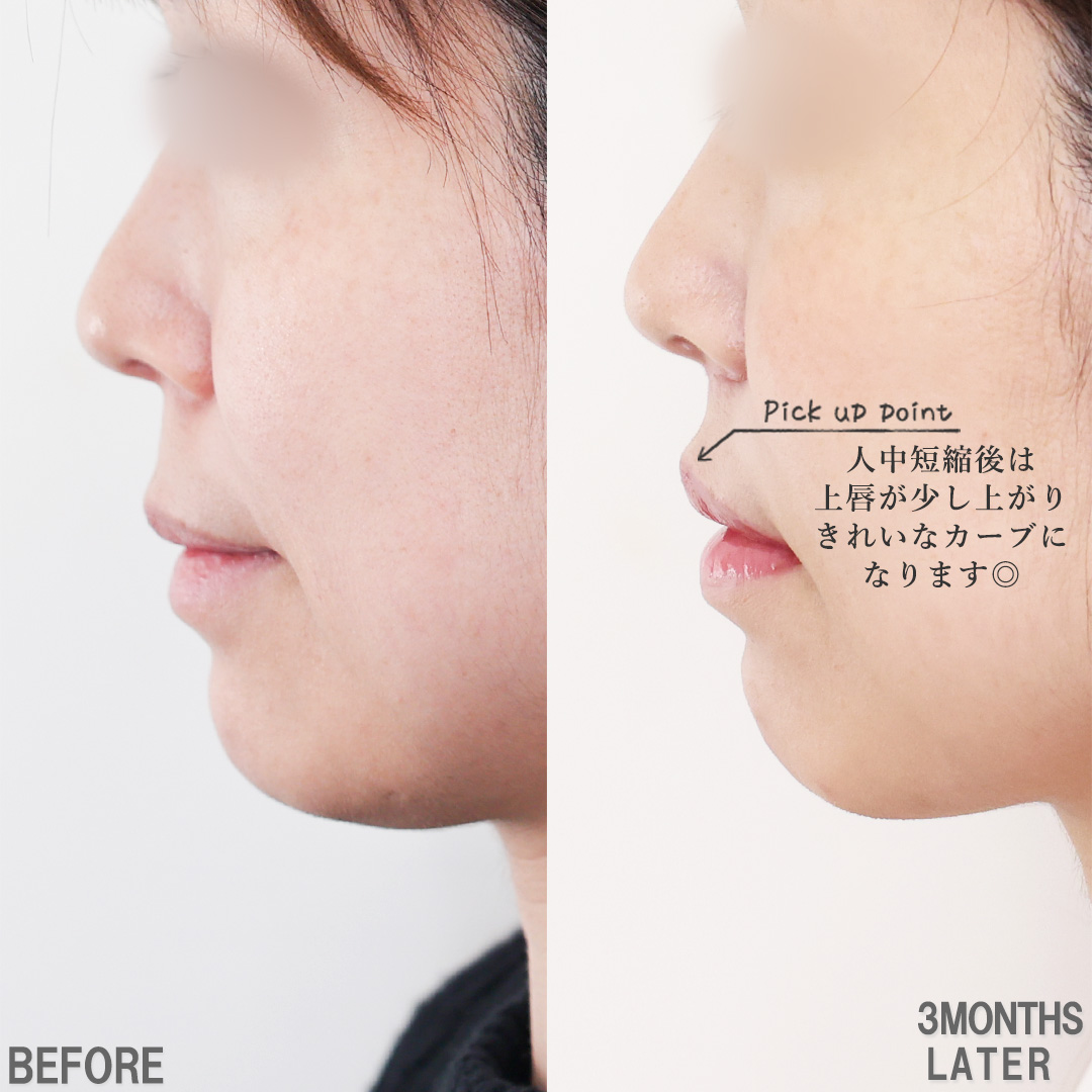 人中短縮術(リップリフト)・外側人中短縮術/口角挙上・リフト（マイクロ切開法・内側法/口内法）の症例写真 施術前後 