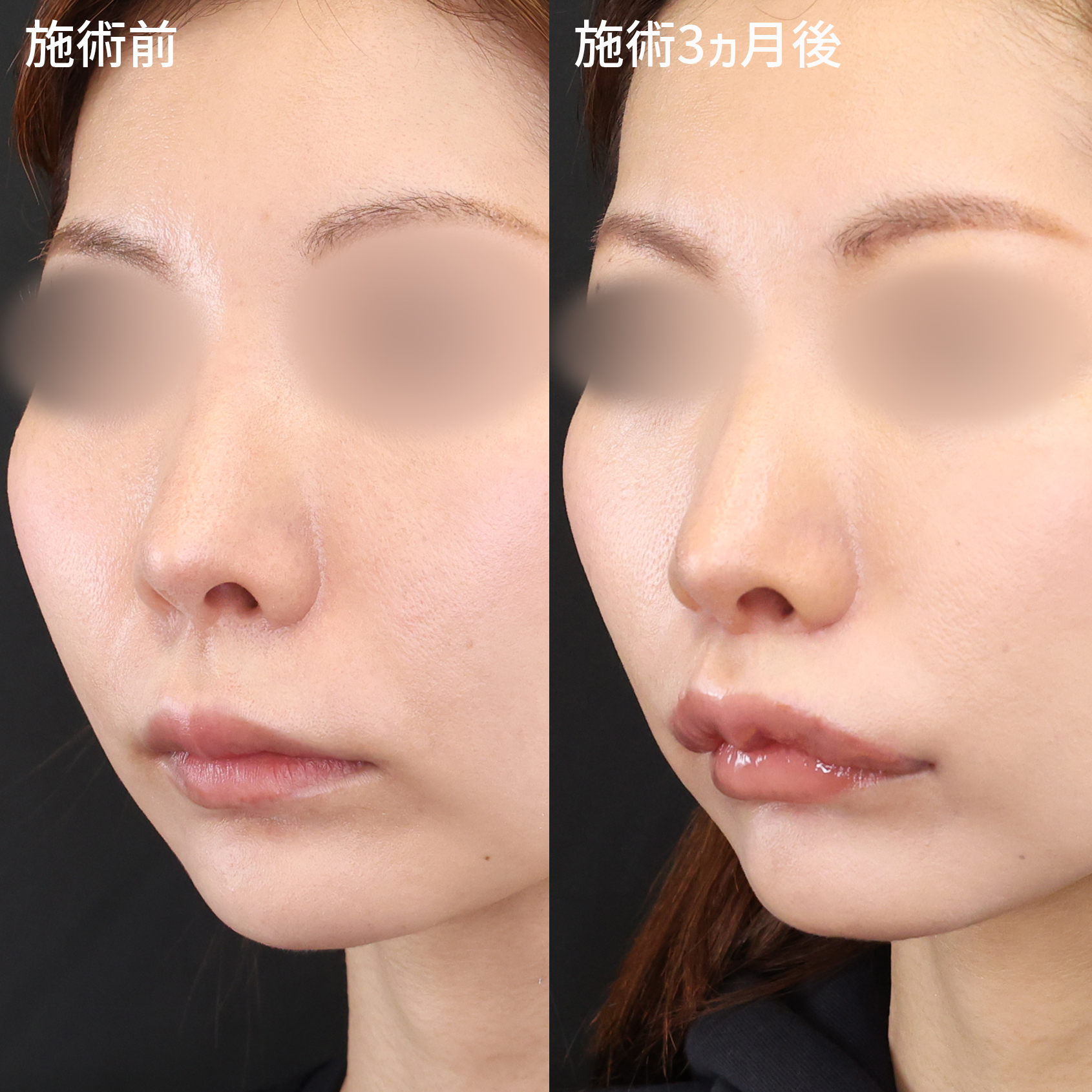 人中短縮術(リップリフト)・外側人中短縮術/M字リップ形成術/口角挙上・リフト（マイクロ切開法・内側法/口内法）の症例写真 施術前後 