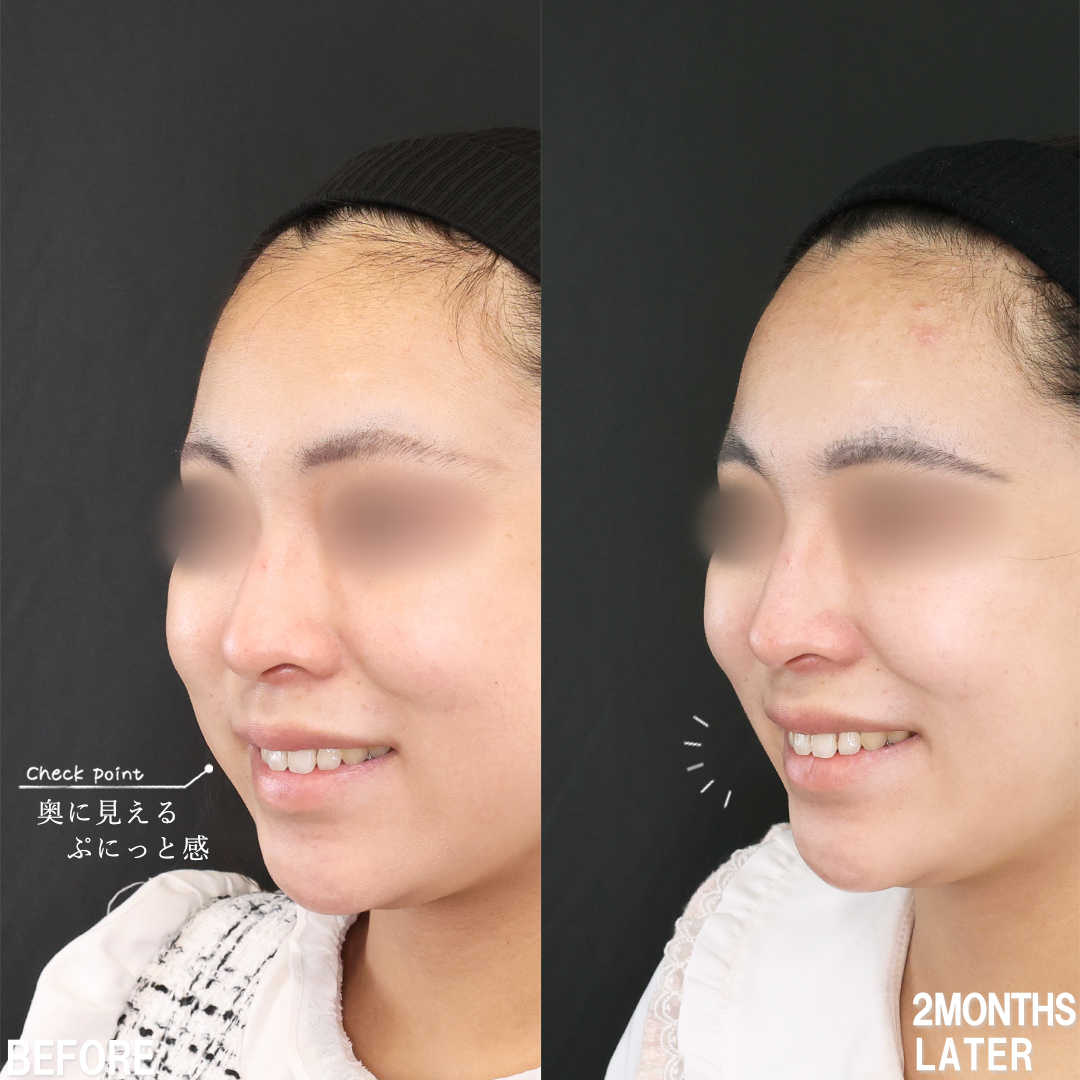 TAC式 ツヤ肌コラーゲンリフト®/バッカルファット除去/顔の脂肪吸引の症例写真 施術前後 