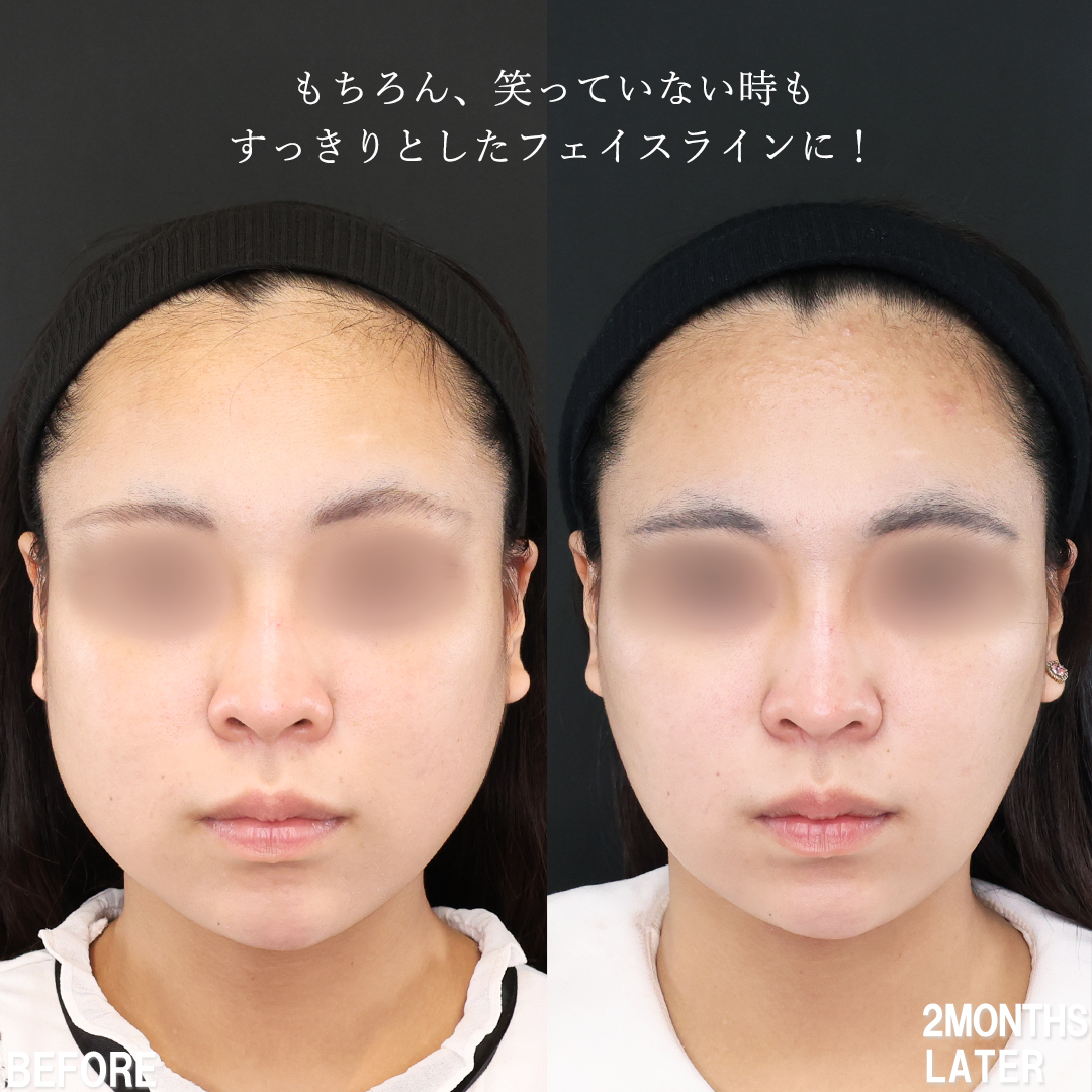 TAC式 ツヤ肌コラーゲンリフト®/バッカルファット除去/顔の脂肪吸引の症例写真 施術前後 