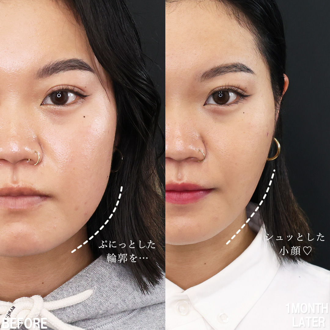 TAC式 ツヤ肌コラーゲンリフト®/バッカルファット除去/Lラインファット除去（エラ下脂肪除去）の症例写真 施術前後 