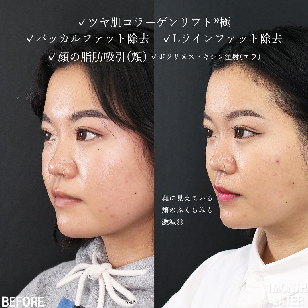 TAC式 ツヤ肌コラーゲンリフト®/バッカルファット除去/Lラインファット除去（エラ下脂肪除去）の症例写真 施術前後 