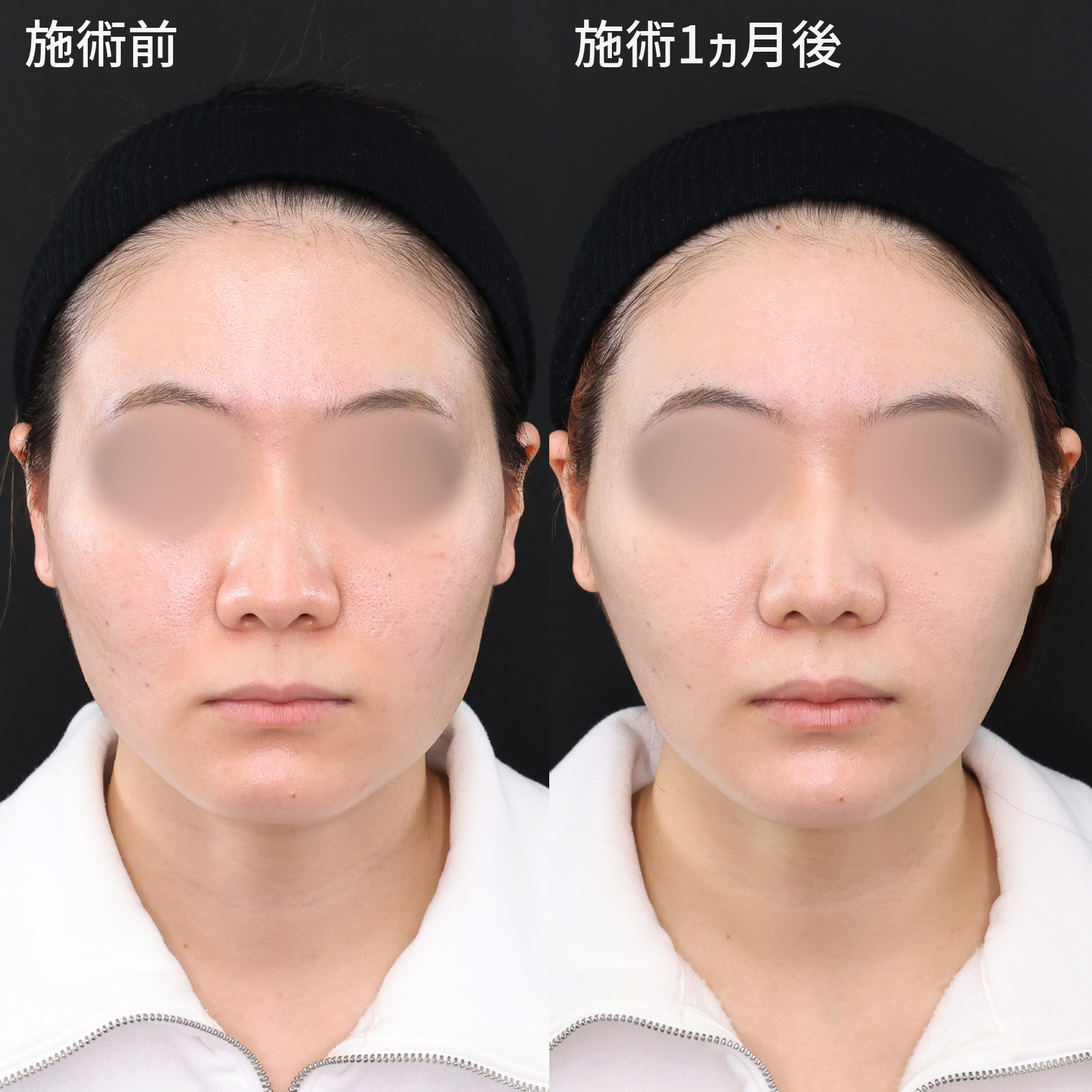 より高い小顔効果の期待できる複合施術【パーフェクトフェイスライン】