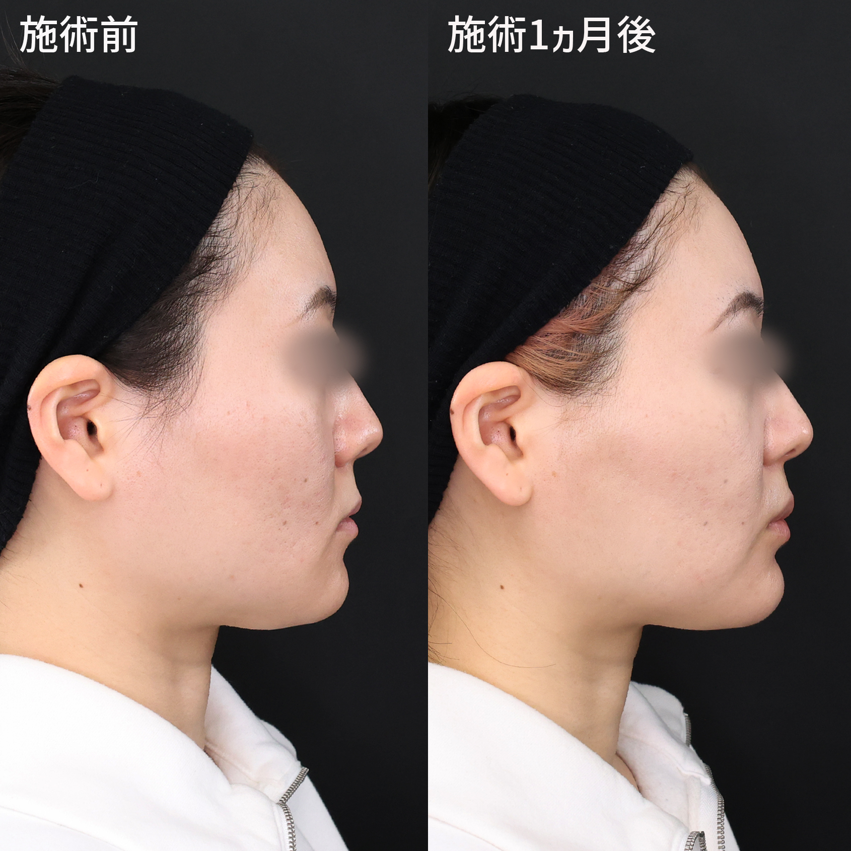 小顔整形｜パーフェクトフェイスライン/TAC式 ツヤ肌コラーゲンリフト®/メーラーファット除去の症例写真 施術前後 