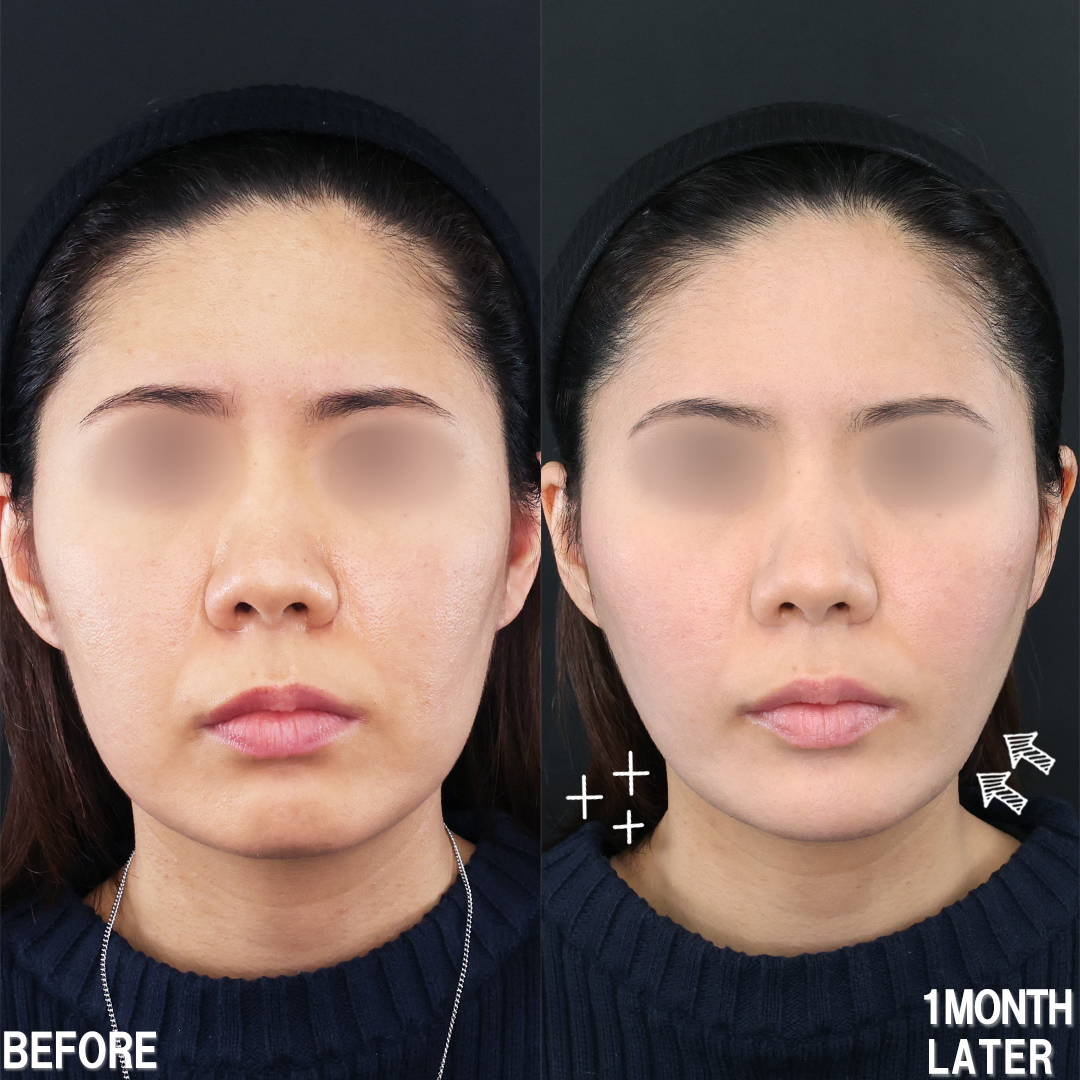 TAC式 ツヤ肌コラーゲンリフト®/顔の脂肪吸引/顎のヒアルロン酸注射の症例写真 施術前後