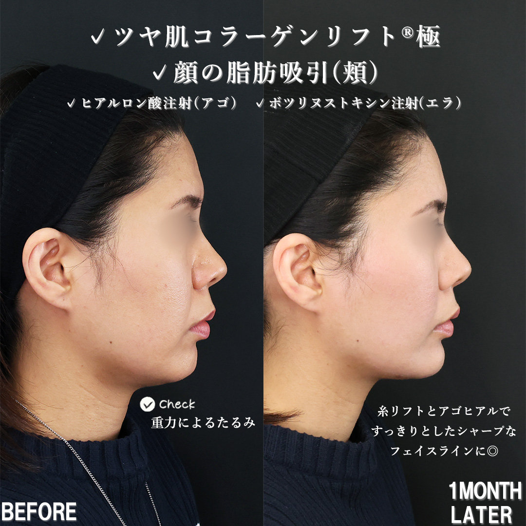 TAC式 ツヤ肌コラーゲンリフト®/顔の脂肪吸引/顎のヒアルロン酸注射の症例写真 施術前後