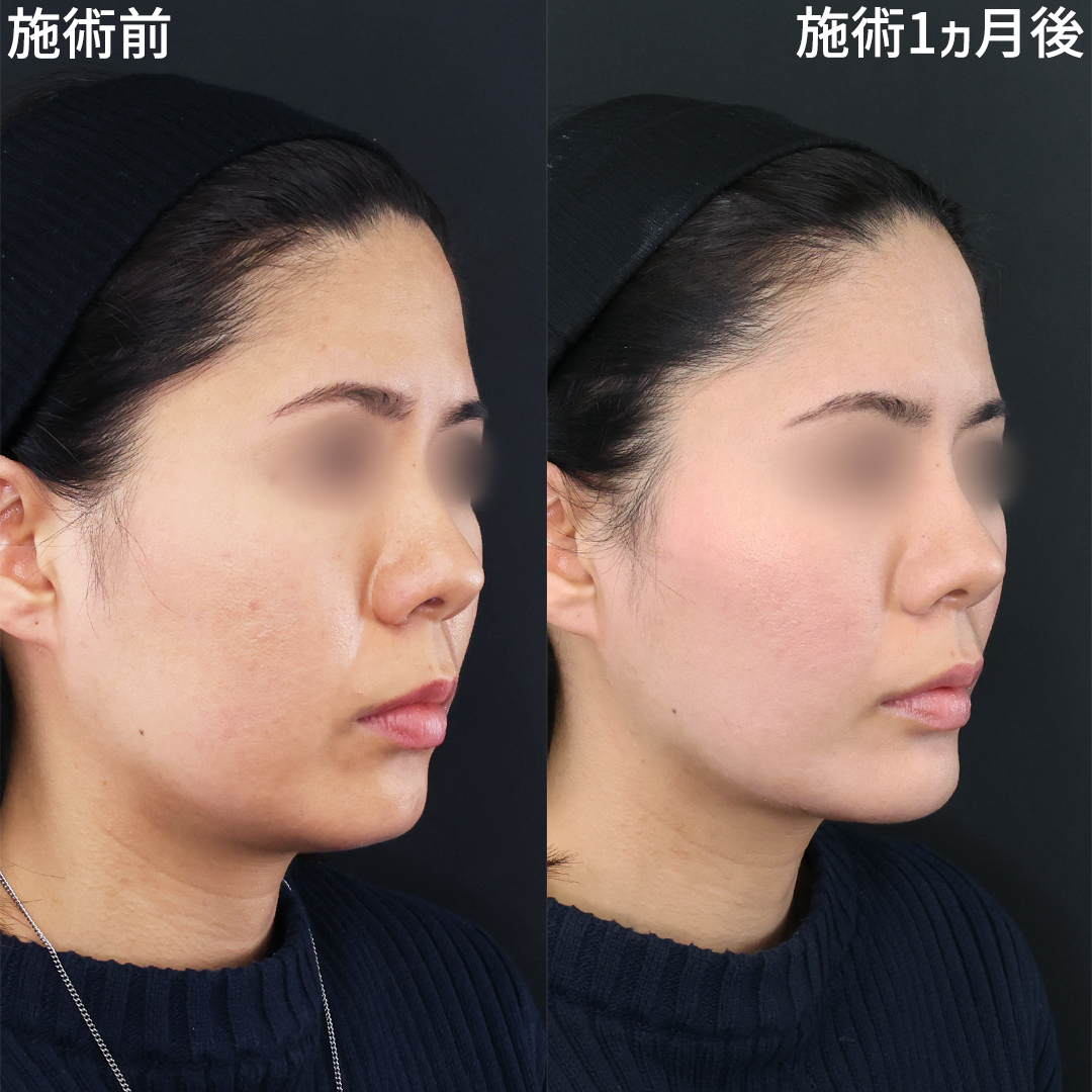 TAC式 ツヤ肌コラーゲンリフト®/顔の脂肪吸引/顎のヒアルロン酸注射の症例写真 施術前後