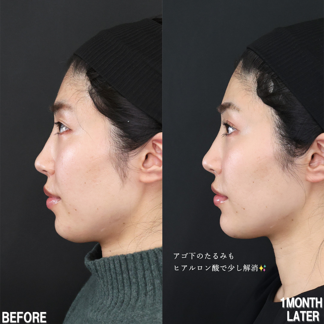 TAC式 ツヤ肌コラーゲンリフト®/TAC式 ショッピングリフト/エラボトックス注射の症例写真 施術前後 