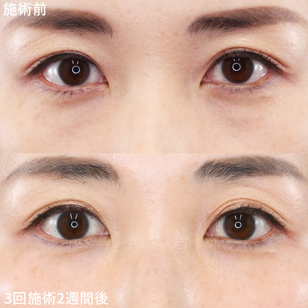 【スネコス注射】目の下のハリ感UP